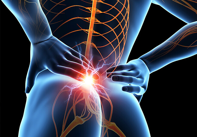 I Think I May Have Sciatica – How Can I Find Relief?